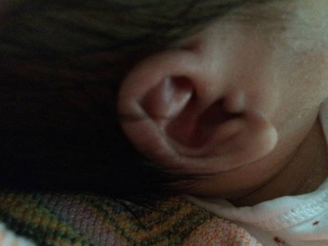 宝宝耳朵畸形怎么办_两只耳朵都是这样的,就那