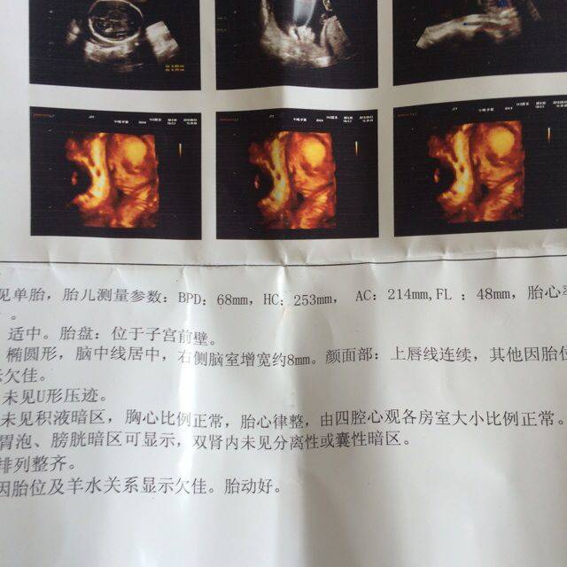20168月4_6个月了做四维彩超右脑偏宽8mm会