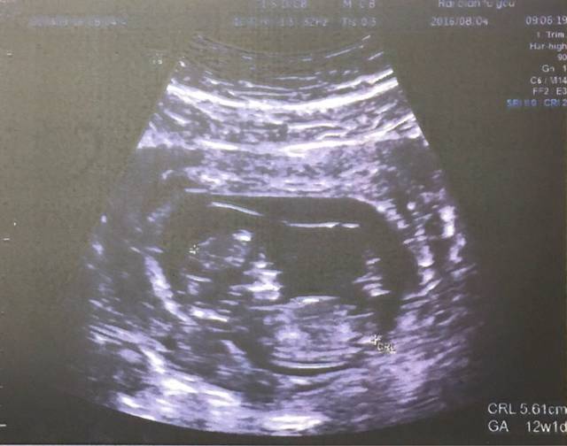 8.4海淀妇幼第一次产检,遇到陈咏玫,比预期的态