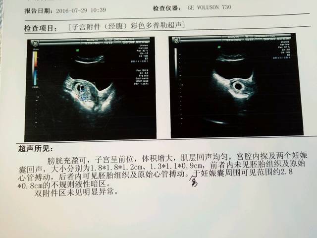 双胎,七周去做B超一个妊娠囊未见胚胎组织与原