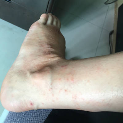 怀孕6个月身上起红疙瘩,但腿上,胳膊上严重,可以用药吗?