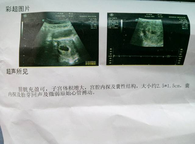 男孩女孩?_看看52天,的孕囊是男孩还是女孩