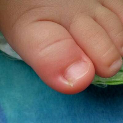 宝宝脚趾红肿,这是怎么了.好像有脓,怎么办?