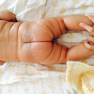 宝宝三个月了，发现屁股两边腿纹不对称一高一低，有类似情况的宝妈们吗?要不要去照b超?好担心。_育儿问答_宝宝树