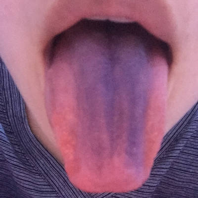 喝完复方钙铁锌口服液舌头发黑怎么回事