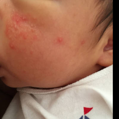 宝宝27天了,脸上长了好多小红点,各位宝妈帮忙看下这是湿疹还是热痱子