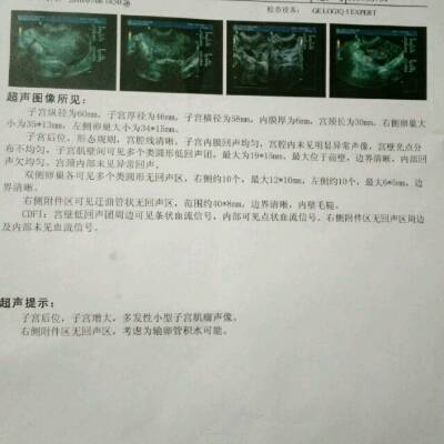 输卵管左侧近端阻塞,右侧通而不畅,盆腔粘连轻度,是做