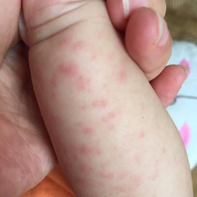 宝宝发烧起了一身红点,和发烧前的热痱子一样