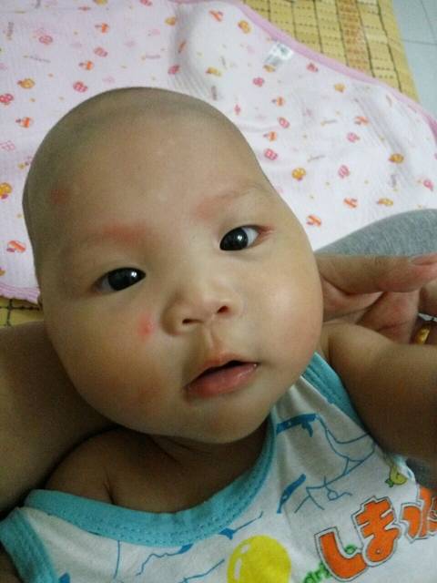 宝宝3个月了脸上白斑怎么回事_宝宝3个月了脸
