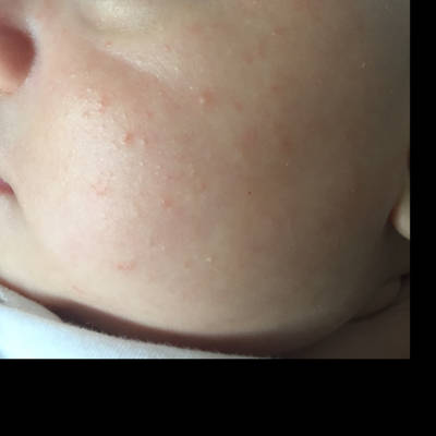 这是湿疹还是热痱子