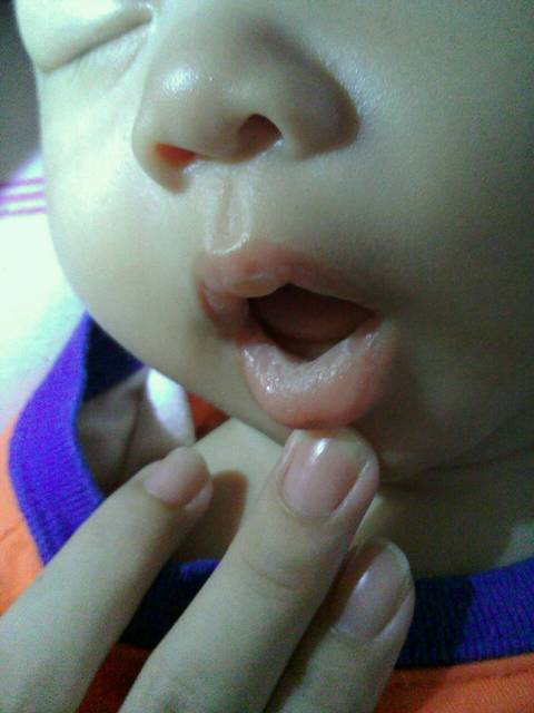 急,求救,求救_我小孩1个月多,这几天发现口腔里