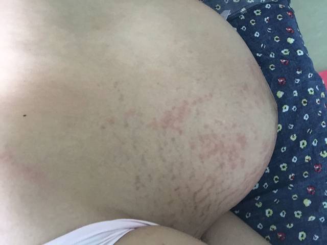 壬辰纹特别痒,胆小的不要看!超级可怕!_身上开