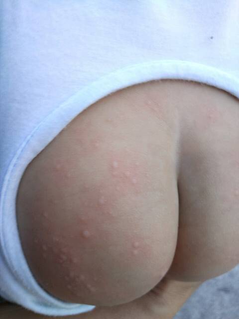 这是湿疹还是荨麻疹啊?_宝宝隔几天身上就发