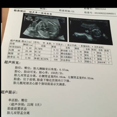 去检查医生告知前置胎盘状态,当医生说到必要时需终止妊娠这四个字的