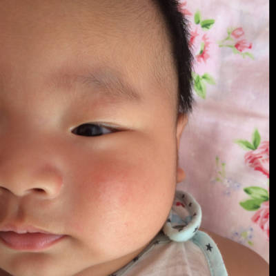 请问有经验的宝妈们看看宝宝脸上的是血管瘤吗