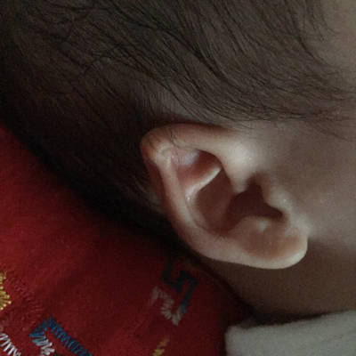 宝宝出生耳朵软骨哪里卷起来该怎么办,然后右