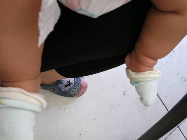 关于小儿腿纹和臀纹不对称的认识()._孩子臀纹