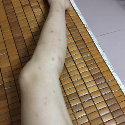 怀孕为什么皮肤会痒,每到晚上睡觉都会痒,一痒