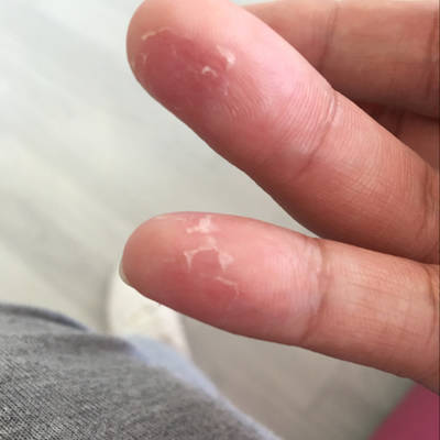 我怀孕五个月,最近突然手指头脱皮怎么办呀?两