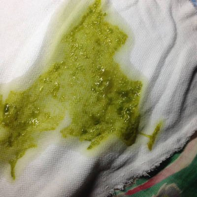 宝宝五个月大拉肚子伴有黏液状,前三四天去查