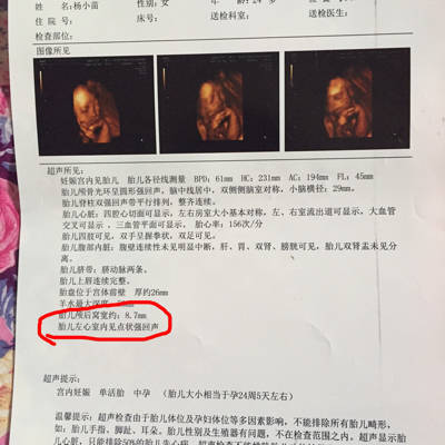 孕25周四维检查胎儿颅后窝8.7mm，左心室有强点回声，会影响胎儿智力发育吗