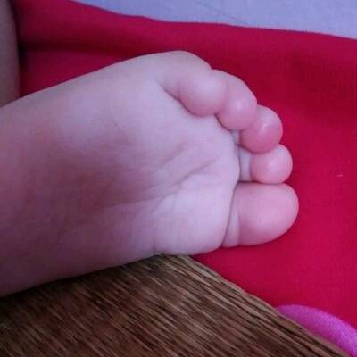 下图我家宝宝有一个脚趾头红肿是怎么回事?求解