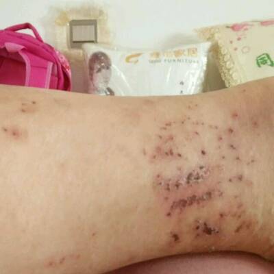 怀孕三十七周了,腿被蚊虫咬了挠破了能用双氧