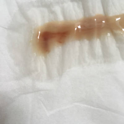 亲爱的宝妈们…现已13周多了,白带出现血性的