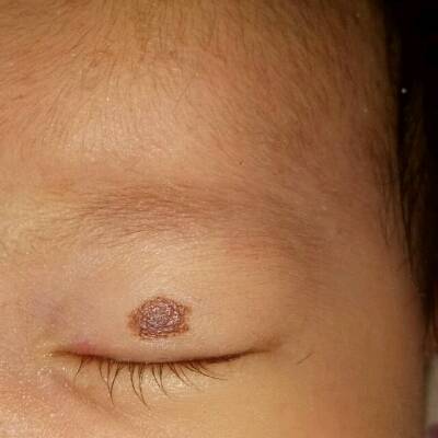 宝宝了快满月了,眼皮上的咖啡斑好像长了一点