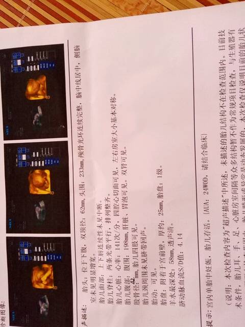 四维彩超_昨天下午做了四维彩超 医生说宝宝动