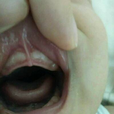 6个月宝宝牙龈有白色貌似牙包一样的东西