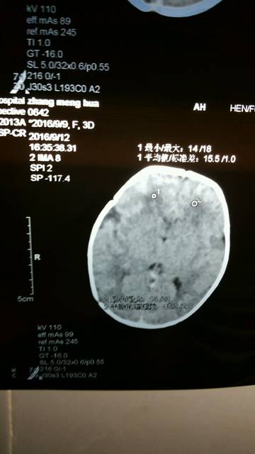 新生婴儿脑部CT。求助_看看这几个点代表什么