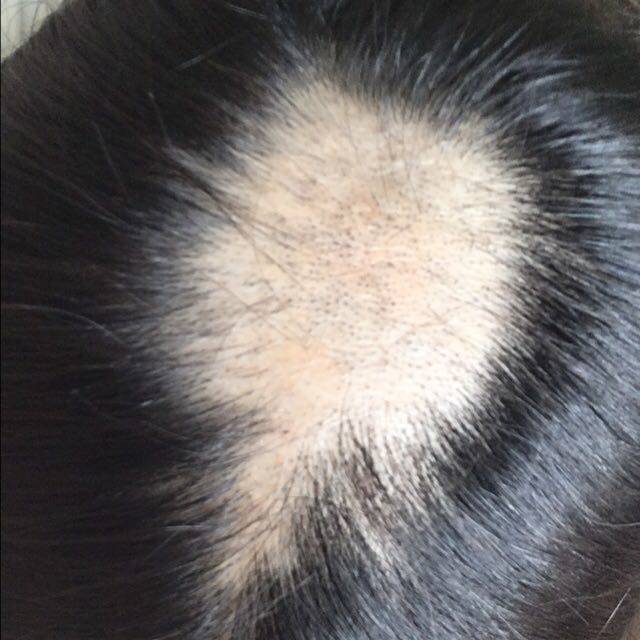 怀孕七个月,严重掉发,形成斑秃_应该为精神压