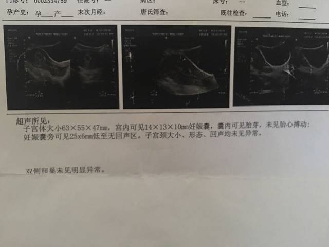 第二次胎停,有保胎成功的吗?(负能量)_去年8.5