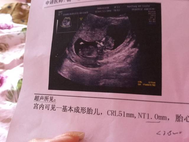 做了NT_但不知道具体怀孕几周第几天了。现在