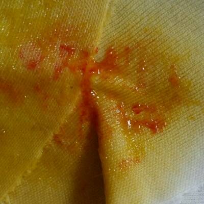 宝宝拉肚子一个星期了,今天拉的便便里有红色