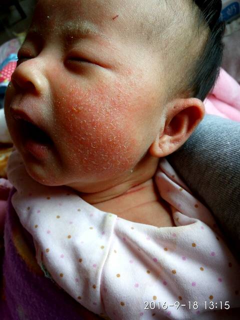 宝宝脸上的这是什么_宝宝脸上出了好多小红痘