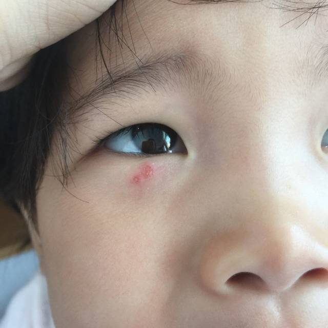 宝宝眼睛下方长了红疙瘩