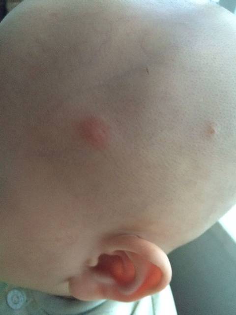 宝宝头皮起包好频繁最近,各位宝妈有懂的帮我