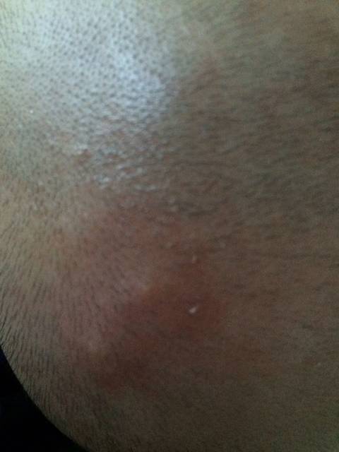 宝宝头皮起包好频繁最近,各位宝妈有懂的帮我