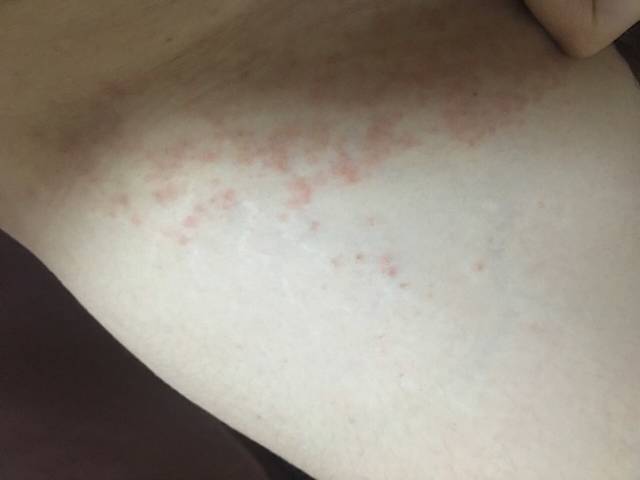 被螨虫咬怎么办?扩散了又像湿疹。_被螨虫咬