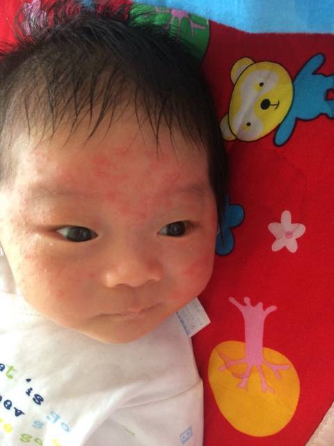 宝宝脸上长红点里面带白头_越来越多,是湿疹还