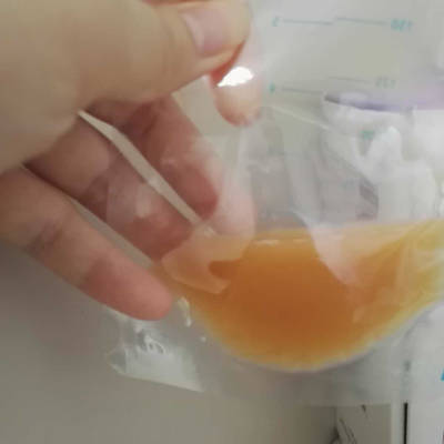 剖腹产后,初乳颜色带血丝怎麼办?能不能吃