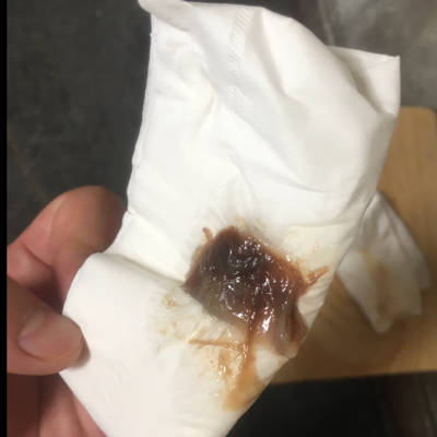 37周5 今天上午开始发现内裤上有褐色粘稠分泌