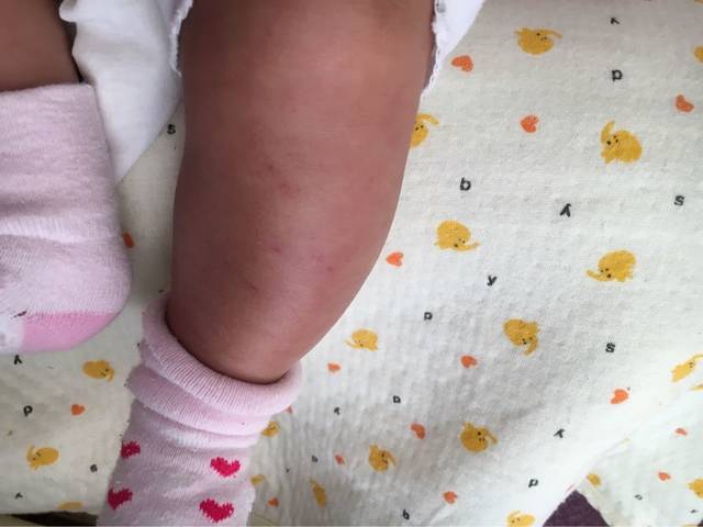 宝宝腿上皮下有红色斑是为啥_如图所示,只有左