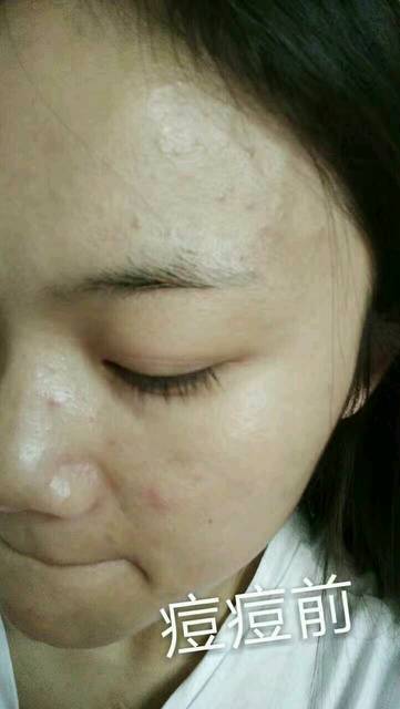 快来看看我的变化_生完宝宝后,满脸长痘痘,皮