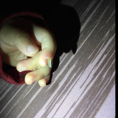 11个月的宝宝手指被门夹了,现在指甲盖脱掉了