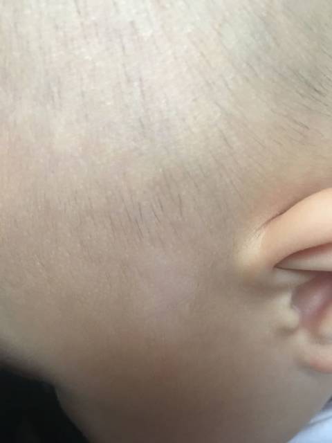 白斑_宝宝脸上有块白斑,说是色素减退斑,烦死