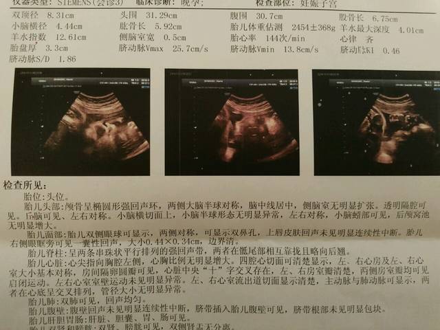 胎儿偏小一周,医生诊断生长受限
