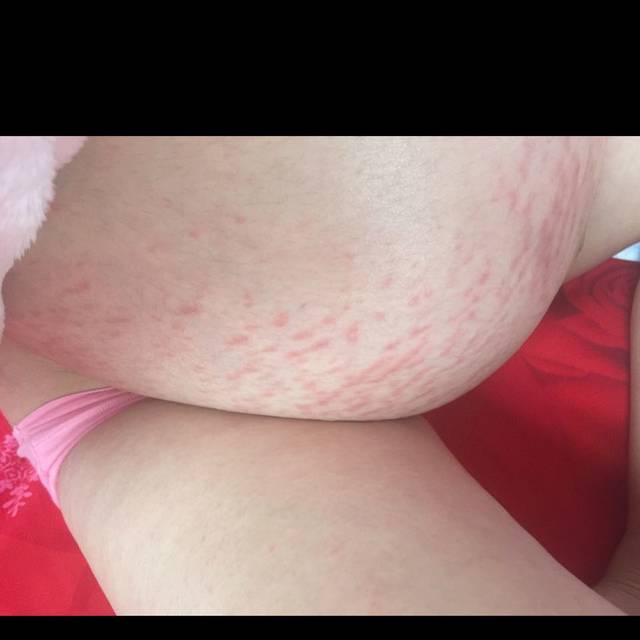 全身长痘痘 怎么办啊?_孕期33周,先是肚子上长